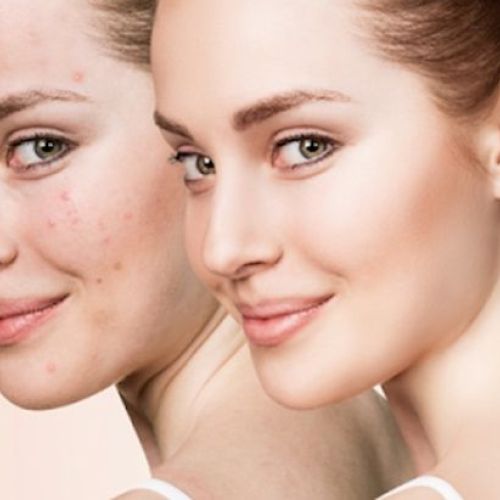 NGUYÊN NHÂN GÂY MỤN PHỔ BIẾN VÀ NHỮNG ĐIỀU CẦN LƯU Ý 